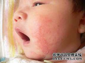 预防儿童湿疹的方法