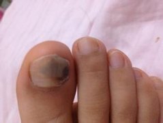 灰指甲疾病的症状有哪些